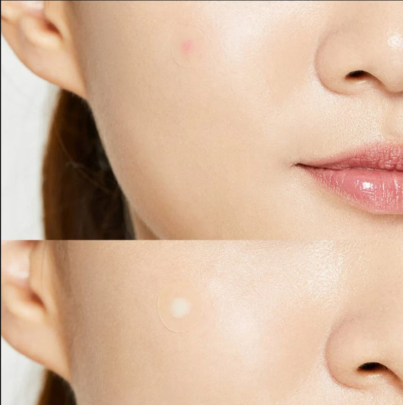 COSRX- Acne Pimple Master Patch